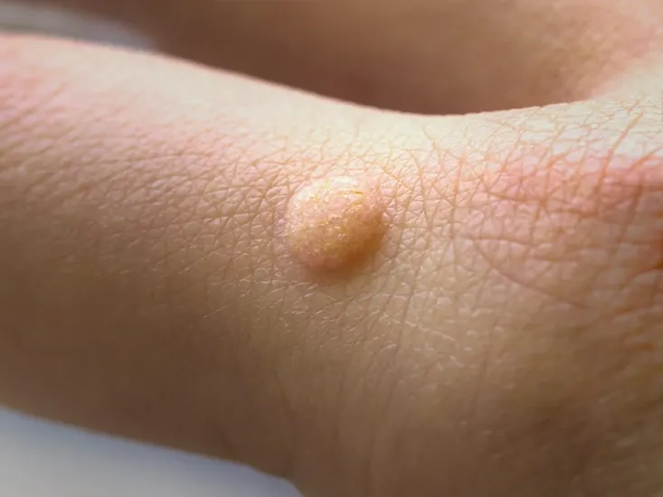 Warts Treatment 13 warts treatment uai