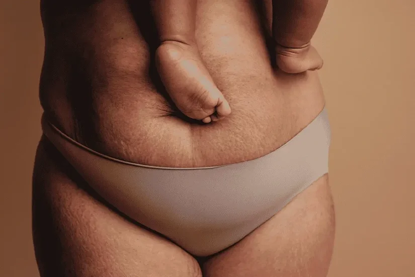What’s Included in a Mommy Makeover Surgery?